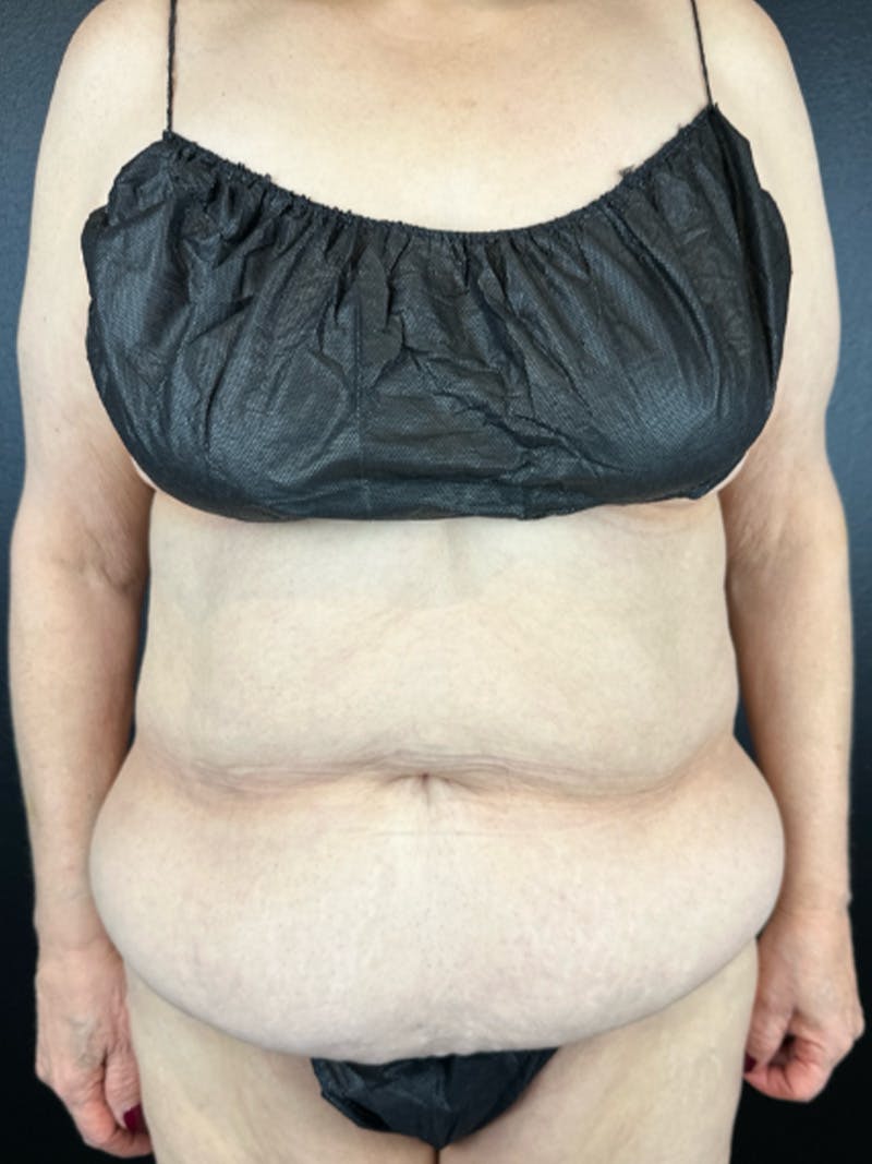 Tummy Tuck Before & After Gallery - Patient 629078 - Image 1