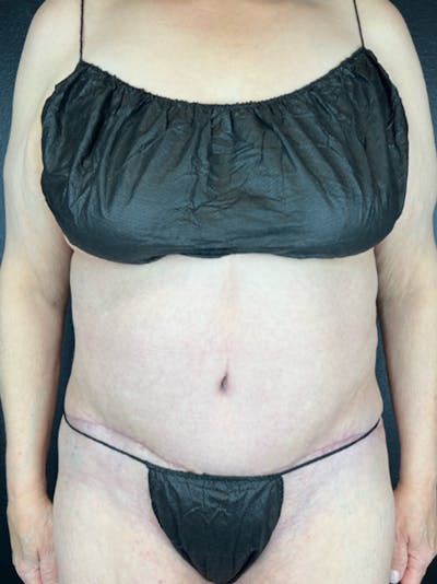 Tummy Tuck Before & After Gallery - Patient 629078 - Image 2