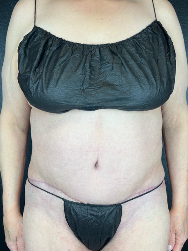 Tummy Tuck Before & After Gallery - Patient 629078 - Image 2
