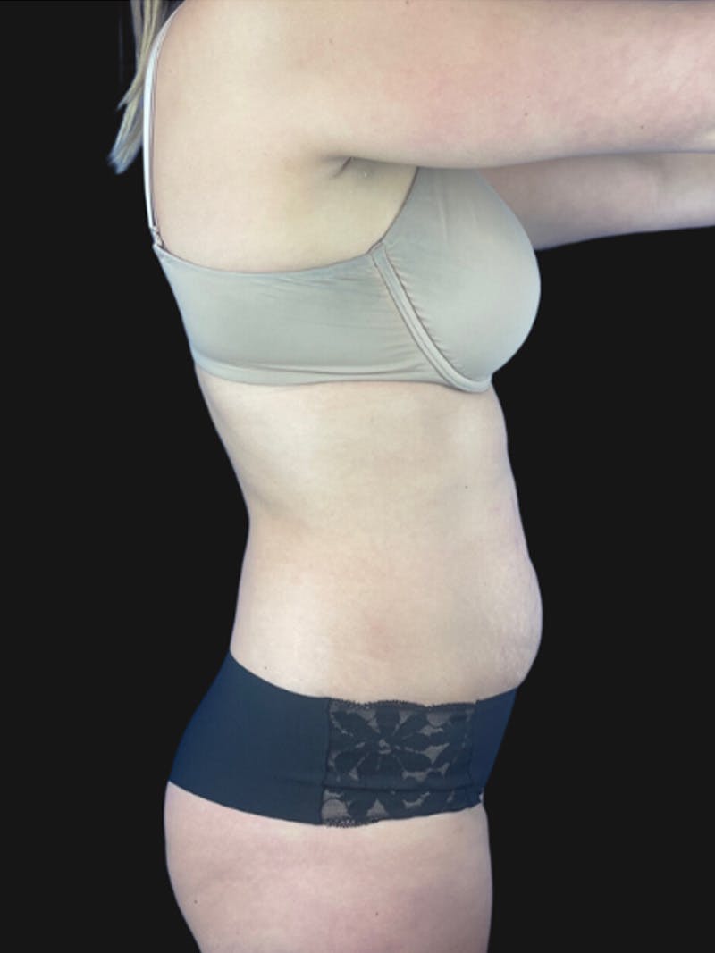 Tummy Tuck Before & After Gallery - Patient 105760 - Image 1