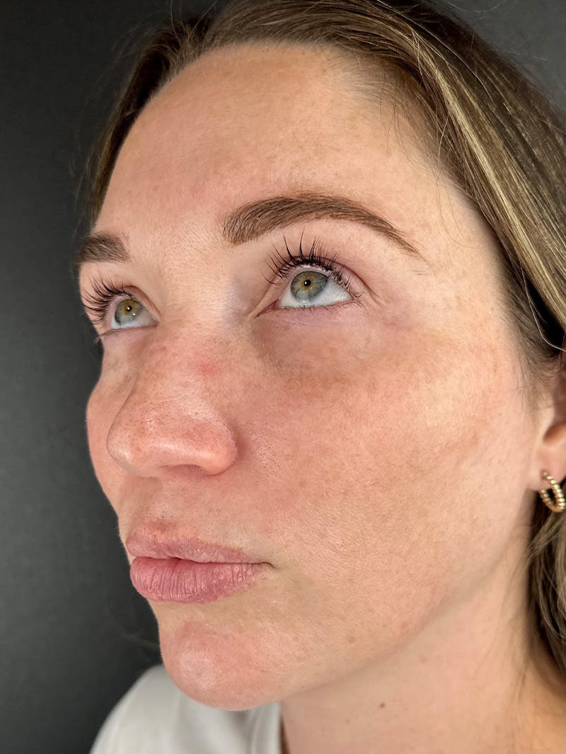 Under Eye Filler Before & After Gallery - Patient 631877 - Image 1