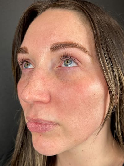 Under Eye Filler Before & After Gallery - Patient 631877 - Image 2