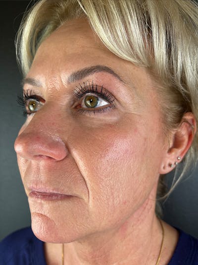 RF Microneedling Before & After Gallery - Patient 519417 - Image 1