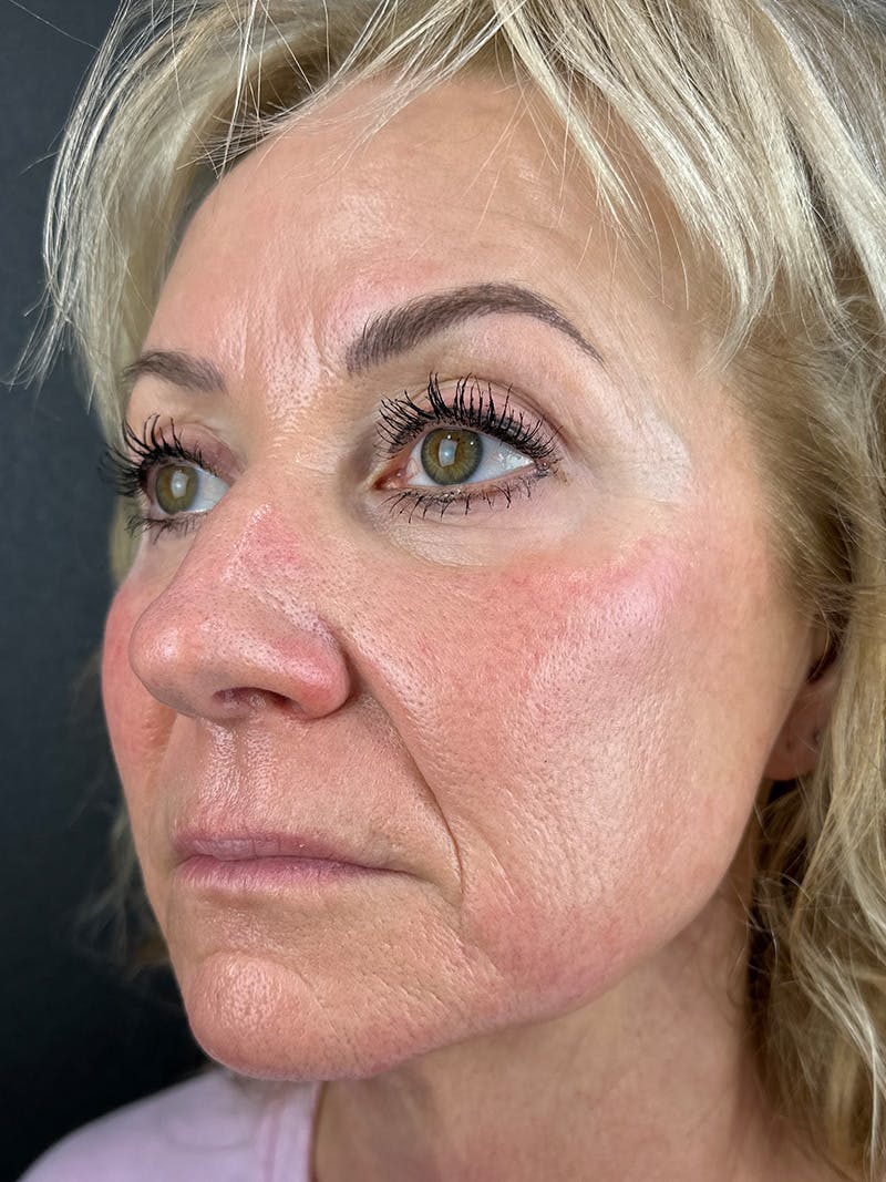 RF Microneedling Before & After Gallery - Patient 519417 - Image 2