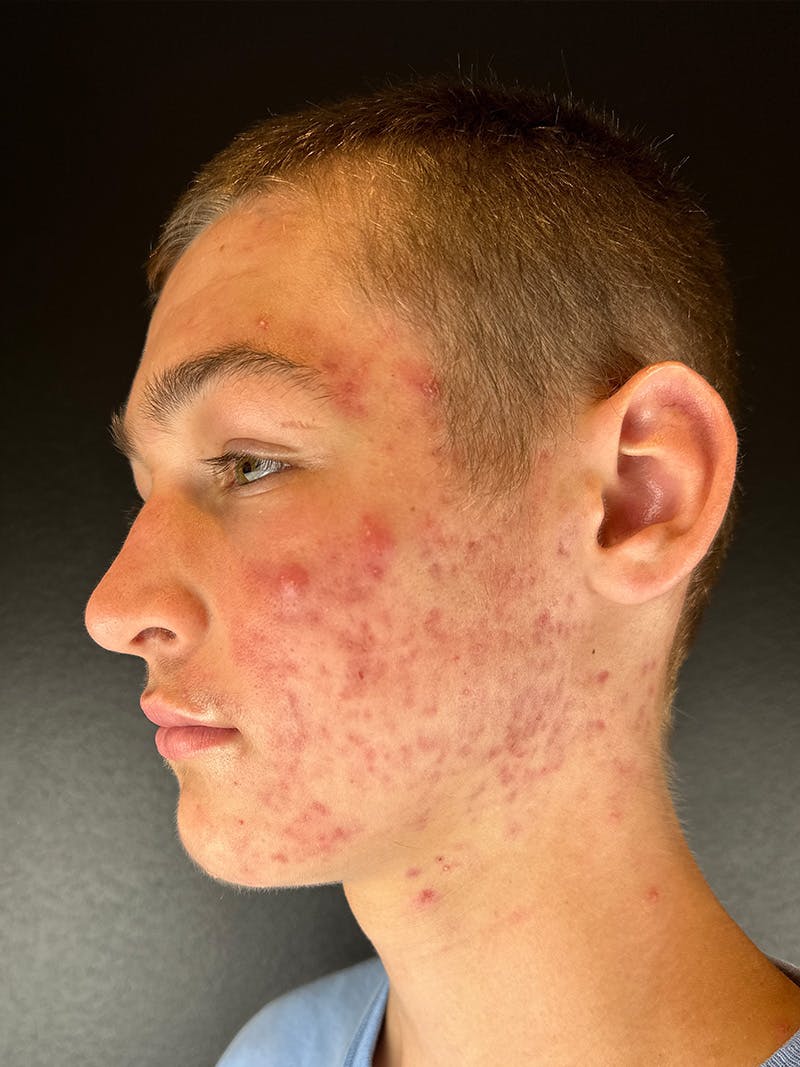 RF Microneedling Before & After Gallery - Patient 236017 - Image 1