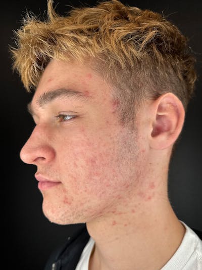 RF Microneedling Before & After Gallery - Patient 236017 - Image 2