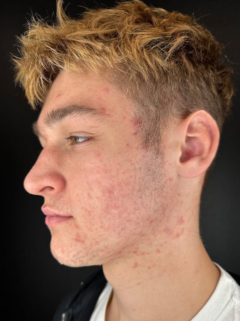 RF Microneedling Before & After Gallery - Patient 236017 - Image 2