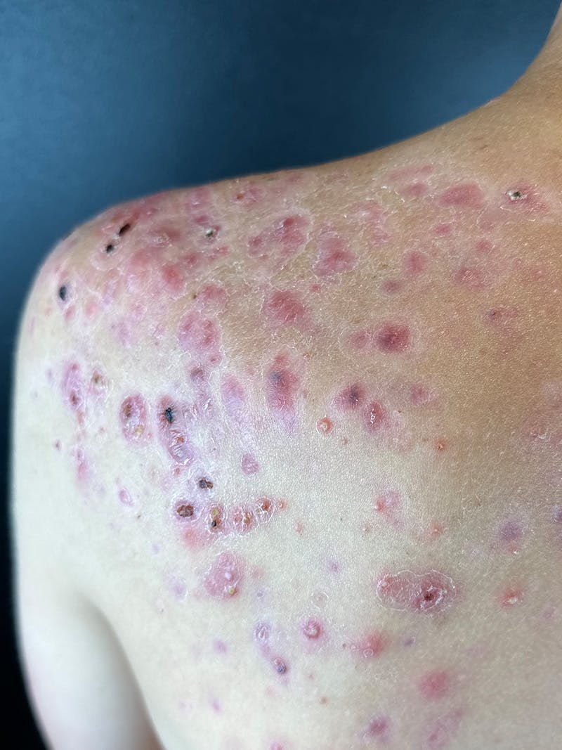 RF Microneedling Before & After Gallery - Patient 236017 - Image 3