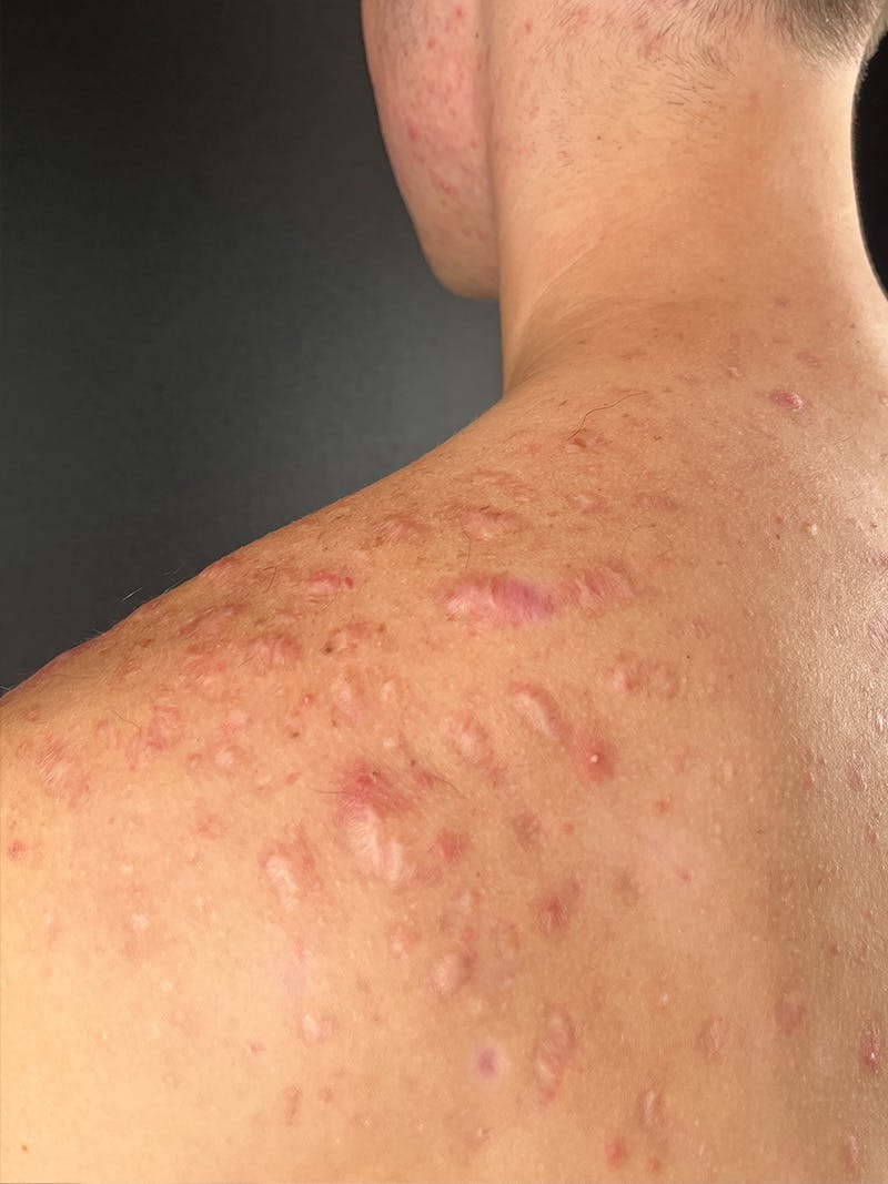 RF Microneedling Before & After Gallery - Patient 236017 - Image 4
