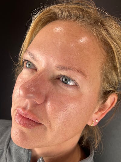 Microblading  Before & After Gallery - Patient 763399 - Image 1