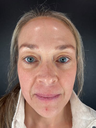 Microblading  Before & After Gallery - Patient 348551 - Image 2