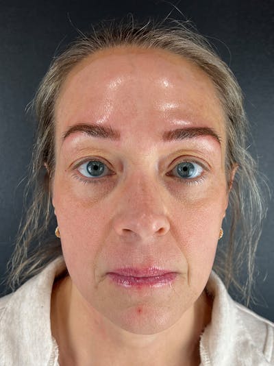 Microblading  Before & After Gallery - Patient 348551 - Image 1