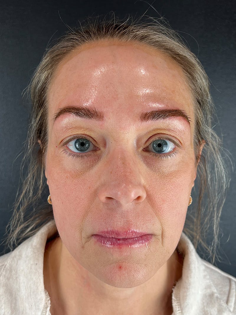 Microblading  Before & After Gallery - Patient 348551 - Image 1