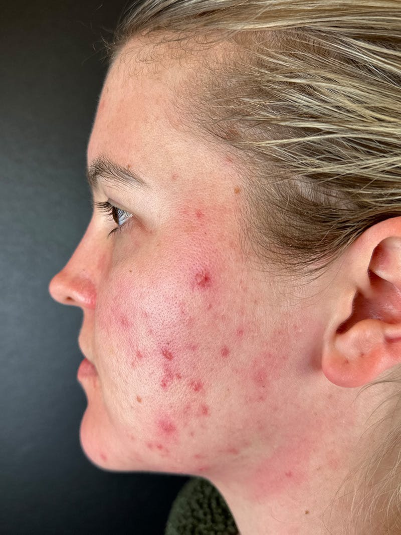 Peels Before & After Gallery - Patient 114098 - Image 1