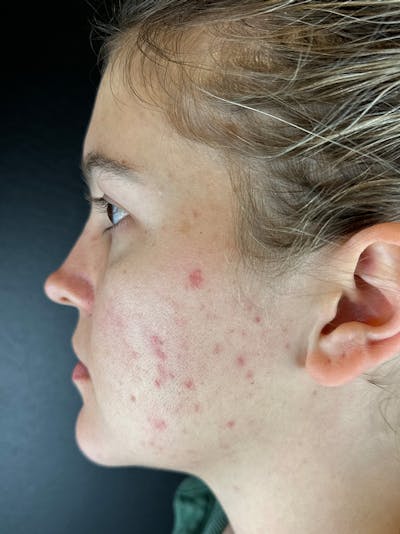 Peels Before & After Gallery - Patient 114098 - Image 2