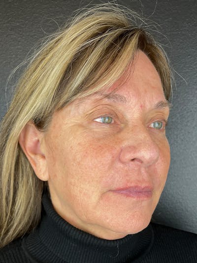 Comprehensive Treatment Plans Before & After Gallery - Patient 347887 - Image 1