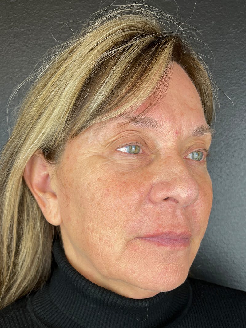 Comprehensive Treatment Plans Before & After Gallery - Patient 347887 - Image 1