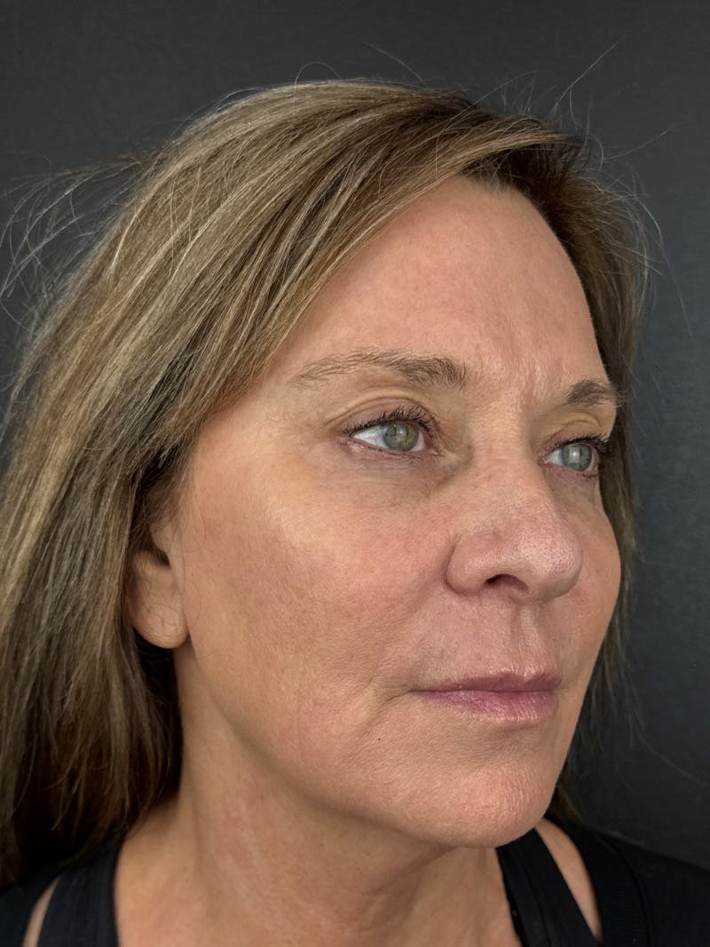 Comprehensive Treatment Plans Before & After Gallery - Patient 347887 - Image 2