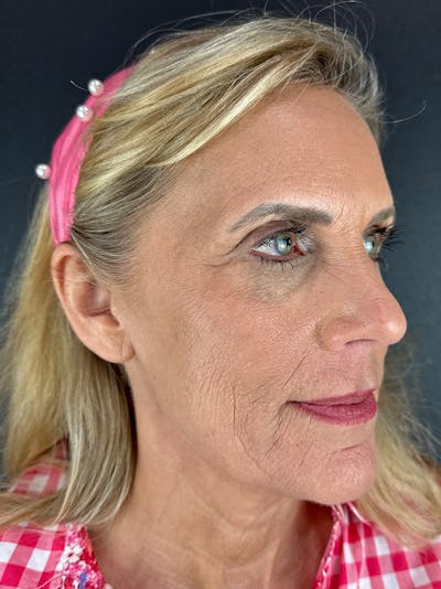 Laser Resurfacing Before & After Gallery - Patient 179657 - Image 1