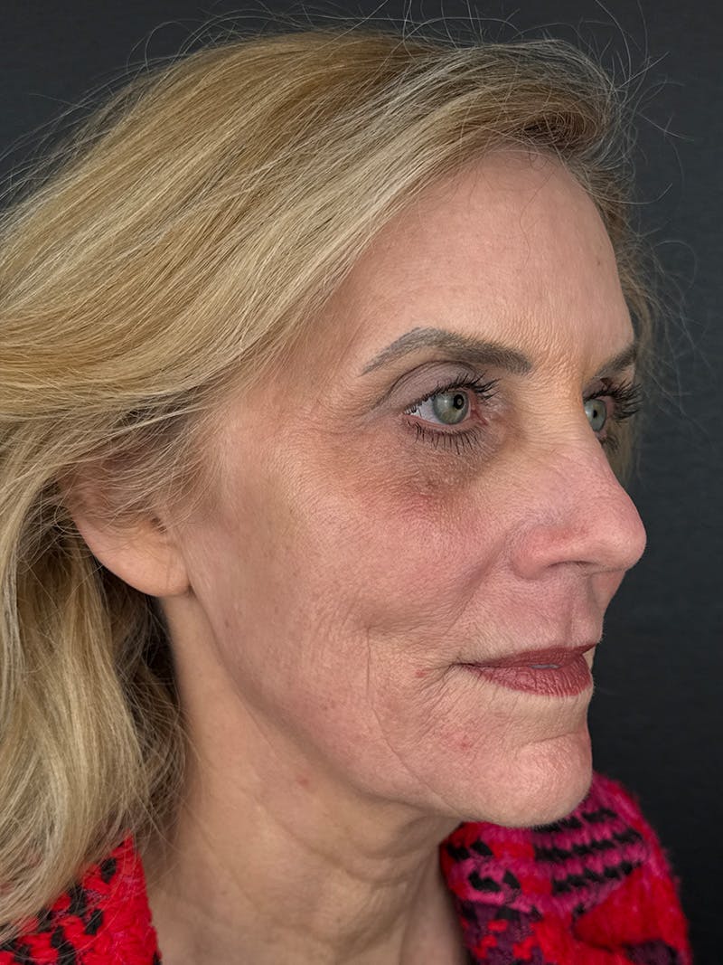 Laser Resurfacing Before & After Gallery - Patient 179657 - Image 2