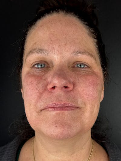 Laser Resurfacing Before & After Gallery - Patient 161583 - Image 1