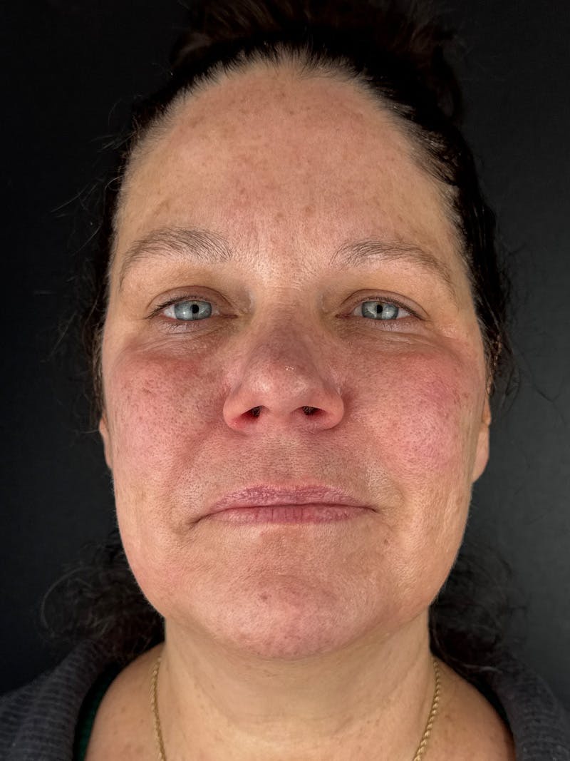 Laser Resurfacing Before & After Gallery - Patient 161583 - Image 1