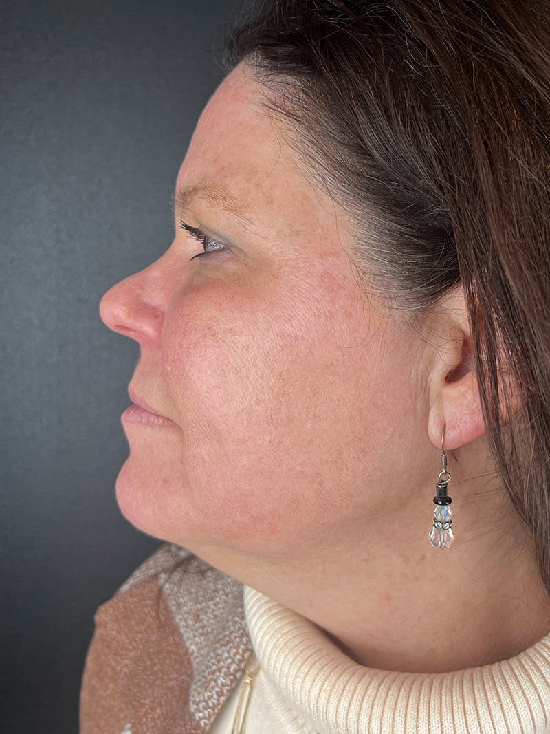 Laser Resurfacing Before & After Gallery - Patient 161583 - Image 4
