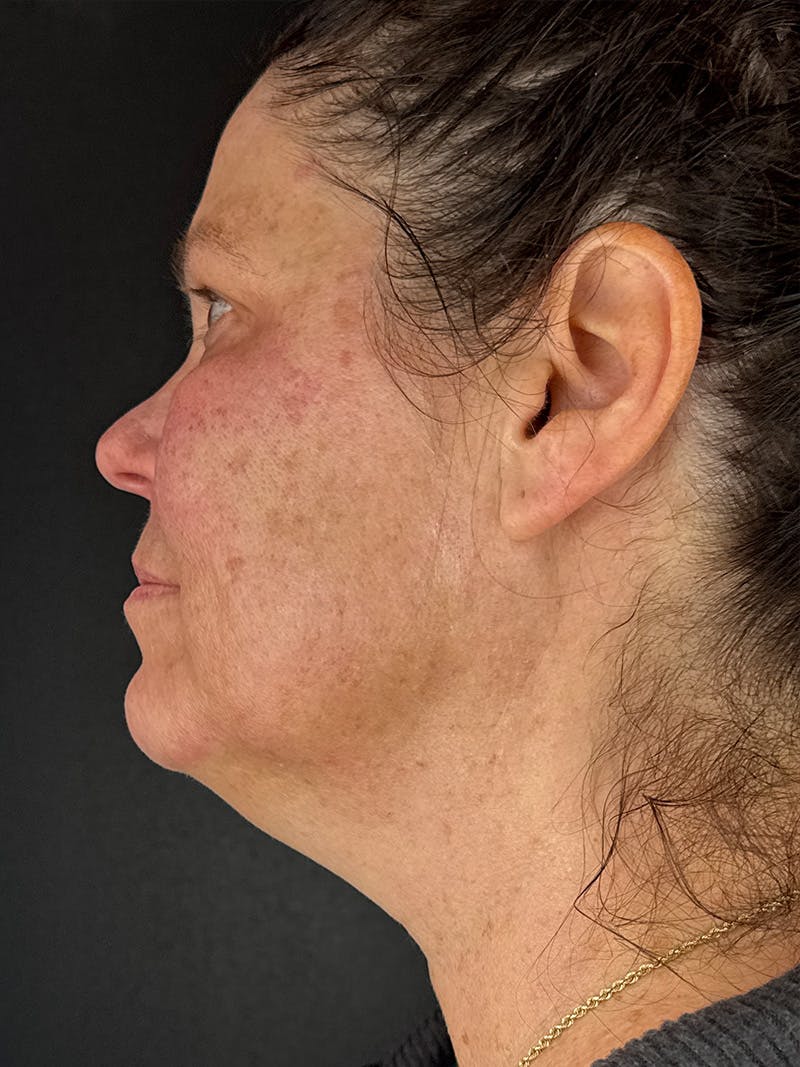 Laser Resurfacing Before & After Gallery - Patient 161583 - Image 3