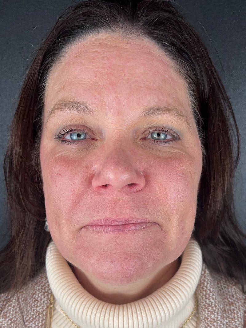 Laser Resurfacing Before & After Gallery - Patient 161583 - Image 2