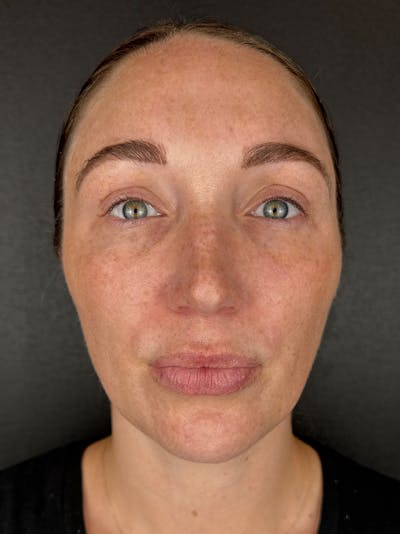 Laser Resurfacing Before & After Gallery - Patient 948390 - Image 1