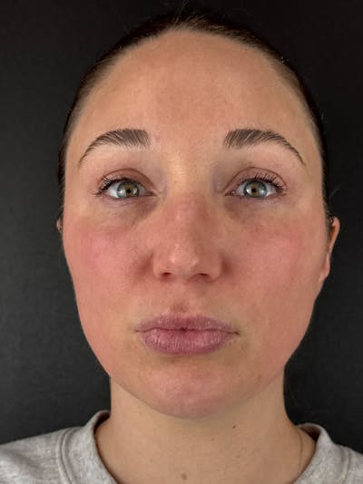 Laser Resurfacing Before & After Gallery - Patient 948390 - Image 2