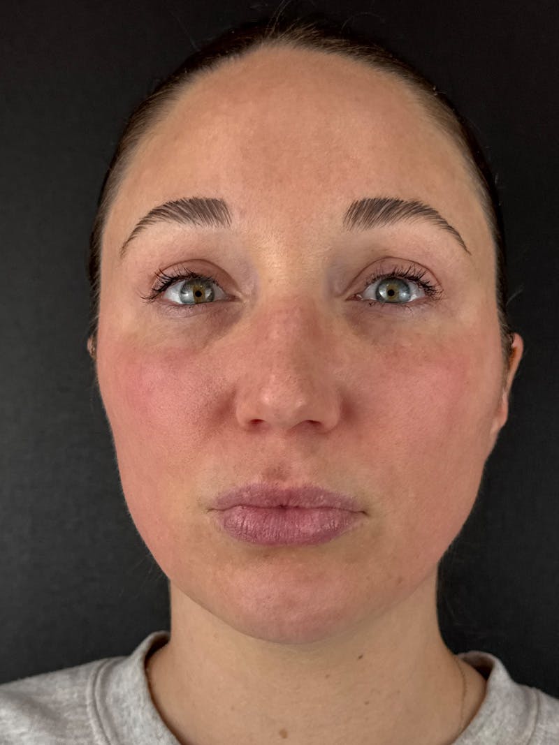 Laser Resurfacing Before & After Gallery - Patient 948390 - Image 2