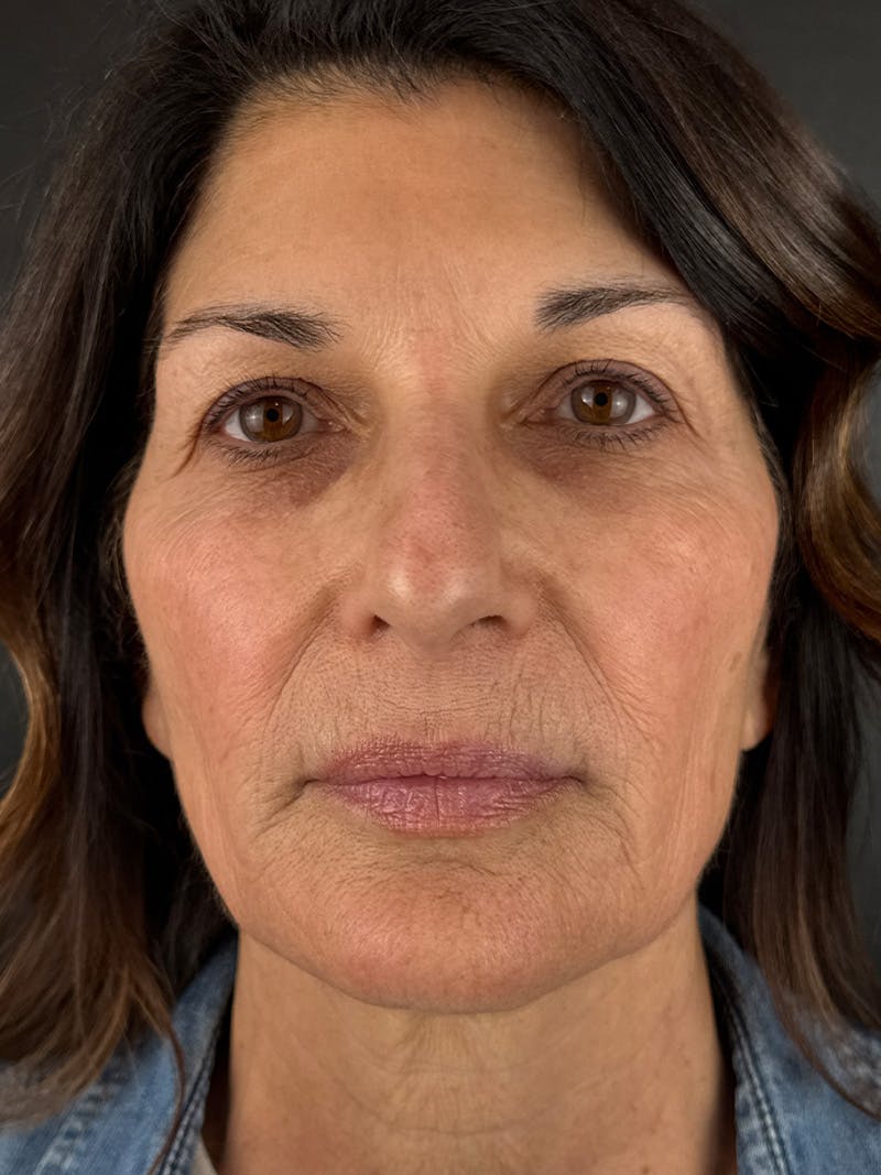 Laser Resurfacing Before & After Gallery - Patient 298336 - Image 1