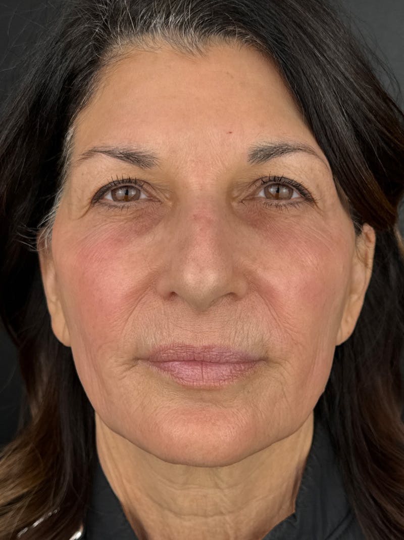Laser Resurfacing Before & After Gallery - Patient 298336 - Image 2