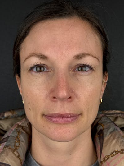 IPL Before & After Gallery - Patient 178975 - Image 1