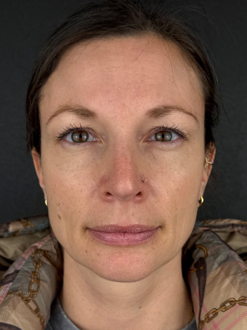 IPL Before & After Gallery - Patient 178975 - Image 1