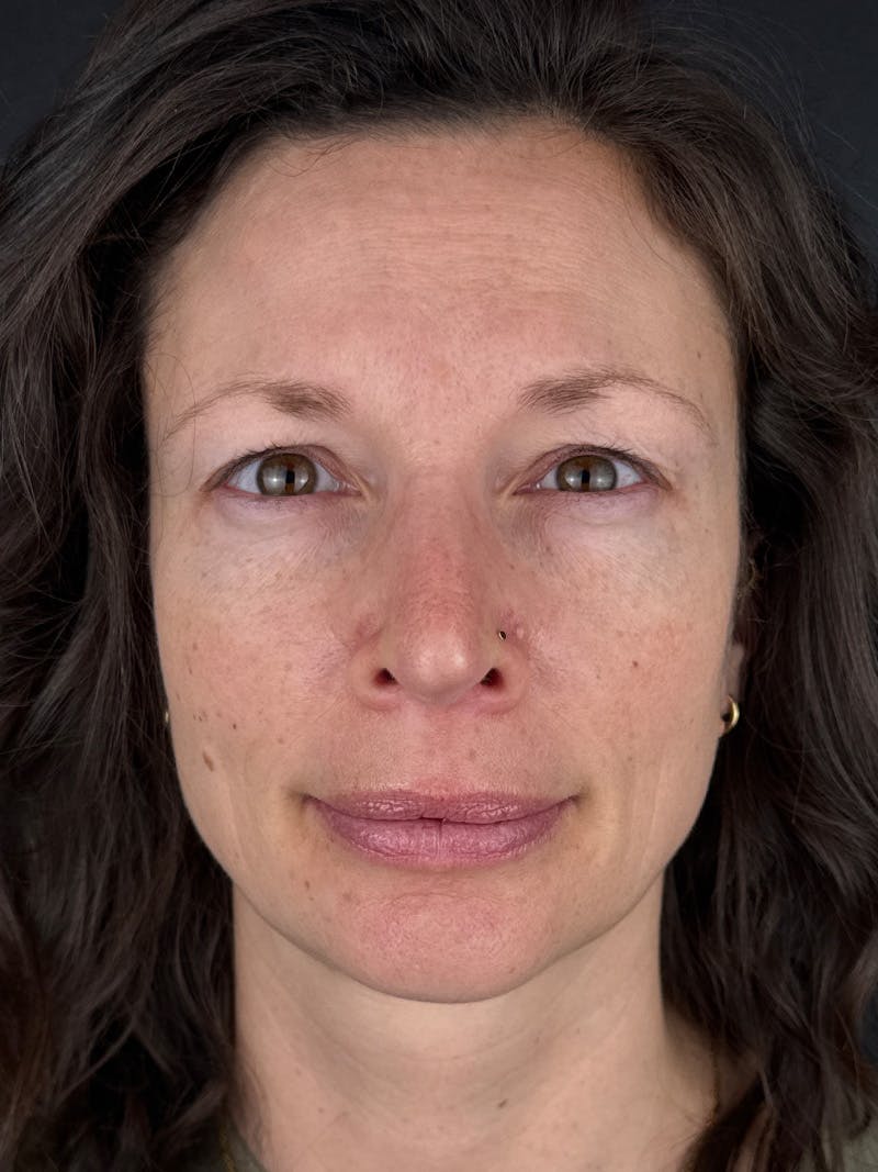 IPL Before & After Gallery - Patient 178975 - Image 2
