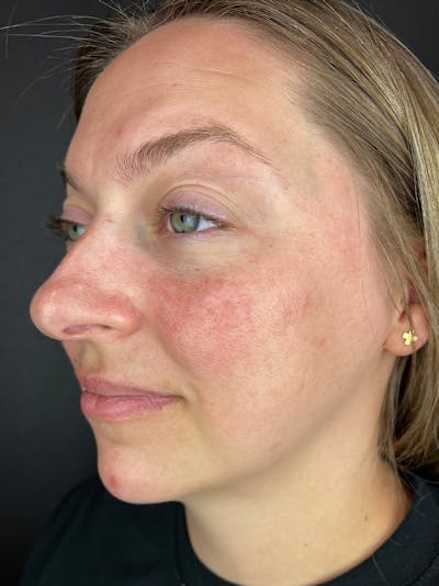 IPL Before & After Gallery - Patient 273483 - Image 1