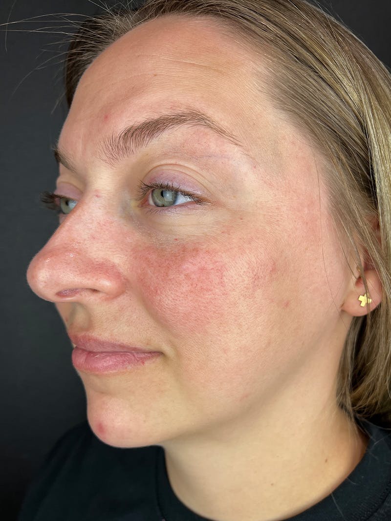 IPL Before & After Gallery - Patient 273483 - Image 1