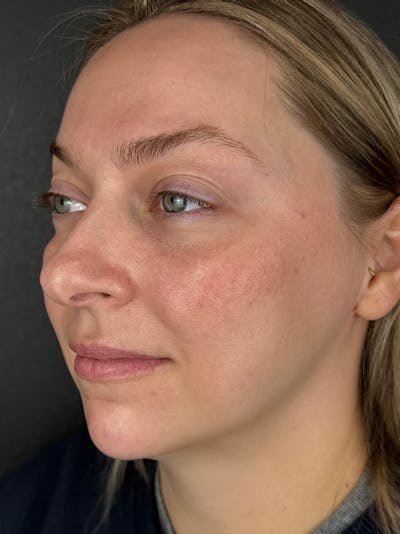 IPL Before & After Gallery - Patient 273483 - Image 2