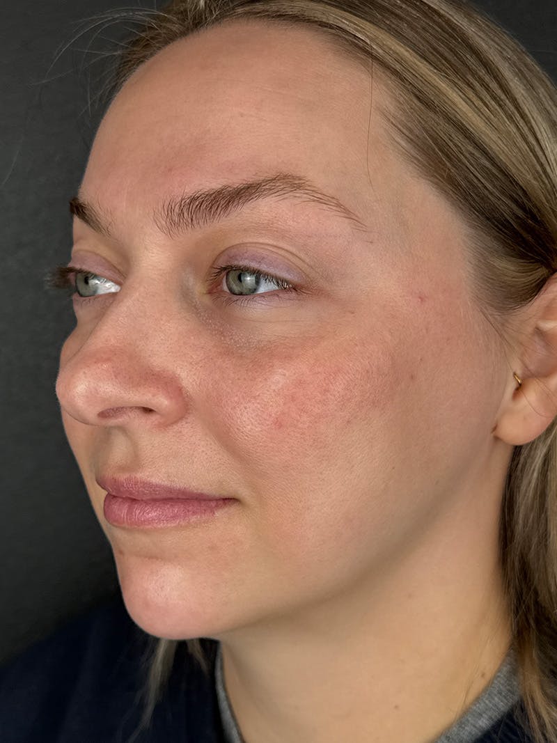 IPL Before & After Gallery - Patient 273483 - Image 2