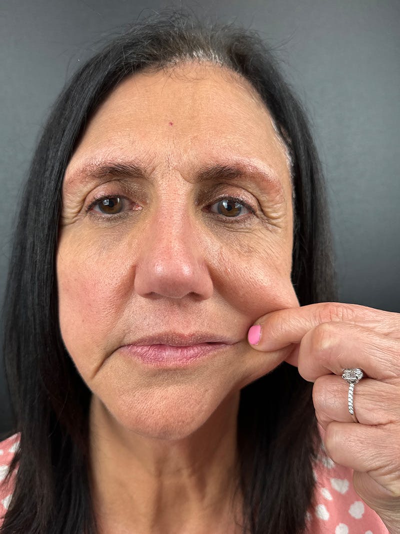 Sculptra Before & After Gallery - Patient 375188 - Image 1