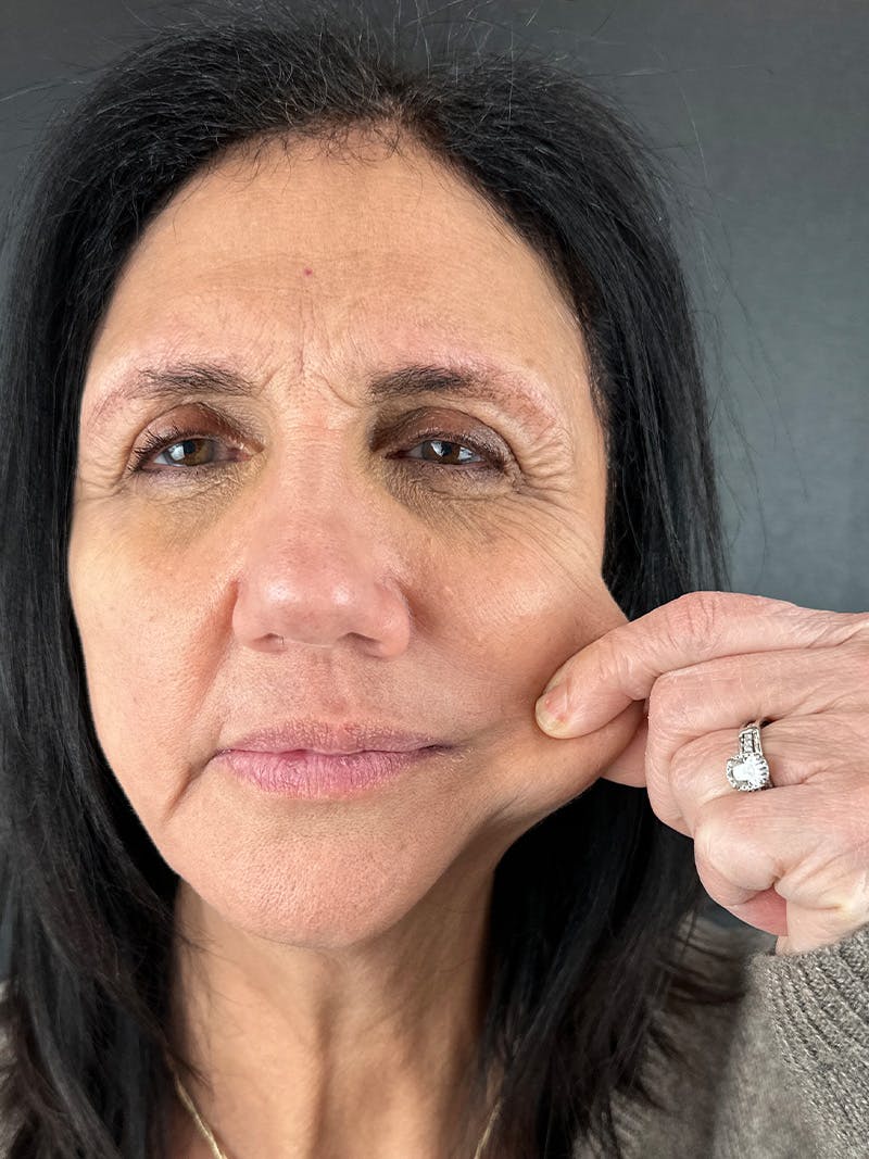 Sculptra Before & After Gallery - Patient 375188 - Image 2
