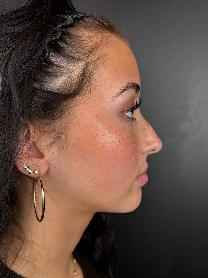 Liquid Rhinoplasty Before & After Gallery - Patient 275471 - Image 1