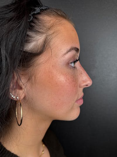 Liquid Rhinoplasty Before & After Gallery - Patient 275471 - Image 2