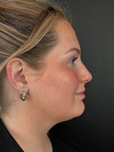 Liquid Rhinoplasty Before & After Gallery - Patient 204242 - Image 1