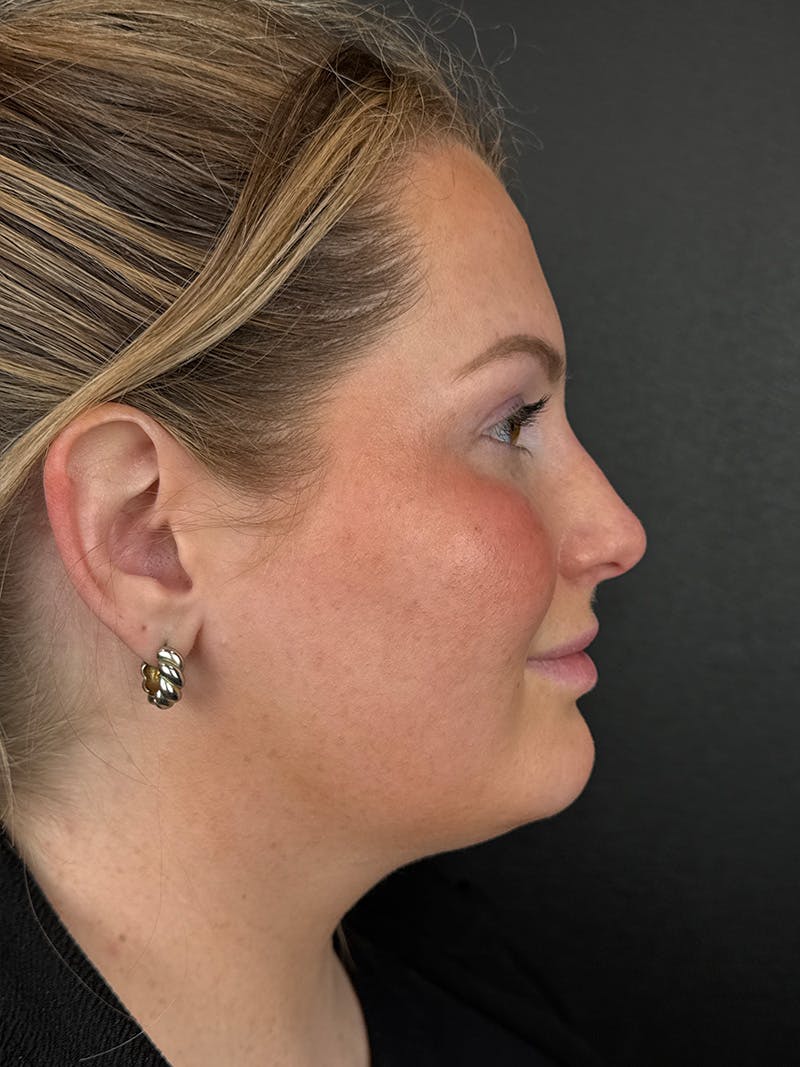 Liquid Rhinoplasty Before & After Gallery - Patient 204242 - Image 1