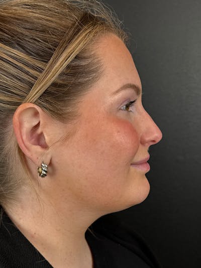 Liquid Rhinoplasty Before & After Gallery - Patient 204242 - Image 2
