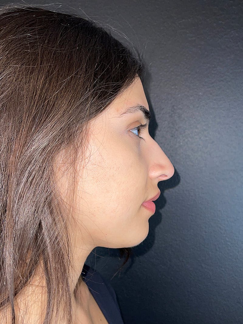 Liquid Rhinoplasty Before & After Gallery - Patient 802963 - Image 1