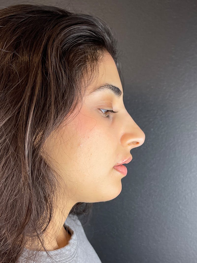 Liquid Rhinoplasty Before & After Gallery - Patient 802963 - Image 2